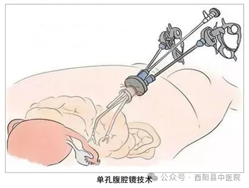 为什么不用切口保护套【首例！】我院妇产科成功开展切口保护套辅助下首例单孔腹腔镜手术！_https://www.jmylbn.com_新闻资讯_第5张