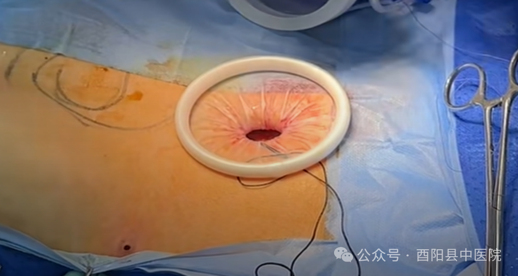 为什么不用切口保护套【首例！】我院妇产科成功开展切口保护套辅助下首例单孔腹腔镜手术！_https://www.jmylbn.com_新闻资讯_第8张