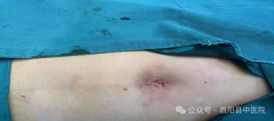 为什么不用切口保护套【首例！】我院妇产科成功开展切口保护套辅助下首例单孔腹腔镜手术！_https://www.jmylbn.com_新闻资讯_第10张