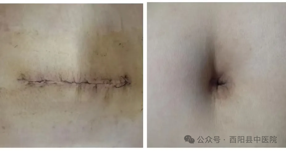 为什么不用切口保护套【首例！】我院妇产科成功开展切口保护套辅助下首例单孔腹腔镜手术！_https://www.jmylbn.com_新闻资讯_第9张