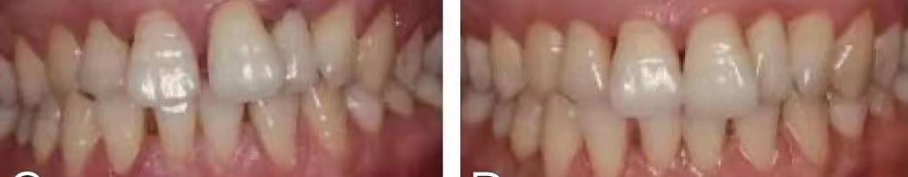 ems洁牙尖怎么分全功能牙周“机王”，带给您不一样的洗牙体验_https://www.jmylbn.com_新闻资讯_第8张