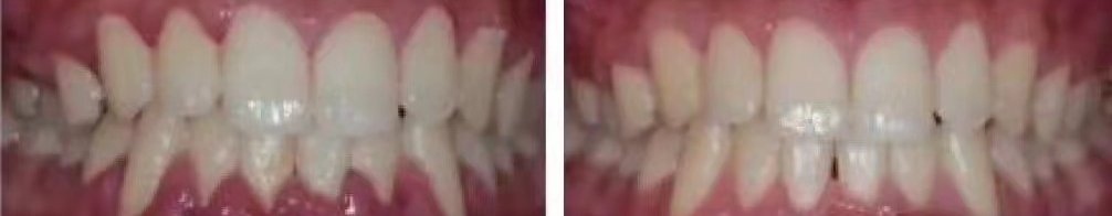 ems洁牙尖怎么分全功能牙周“机王”，带给您不一样的洗牙体验_https://www.jmylbn.com_新闻资讯_第9张