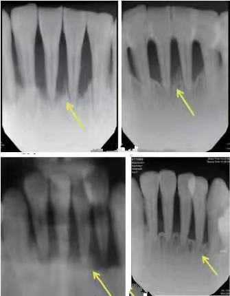 ems洁牙尖怎么分全功能牙周“机王”，带给您不一样的洗牙体验_https://www.jmylbn.com_新闻资讯_第6张