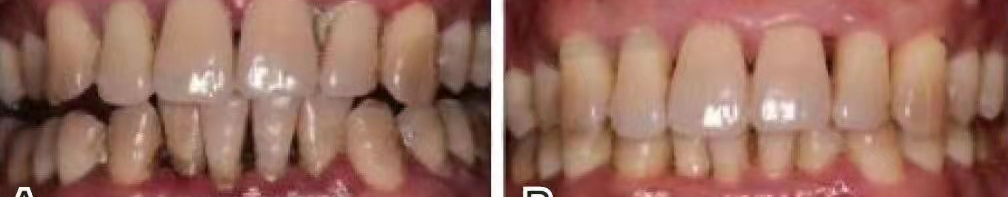 ems洁牙尖怎么分全功能牙周“机王”，带给您不一样的洗牙体验_https://www.jmylbn.com_新闻资讯_第7张