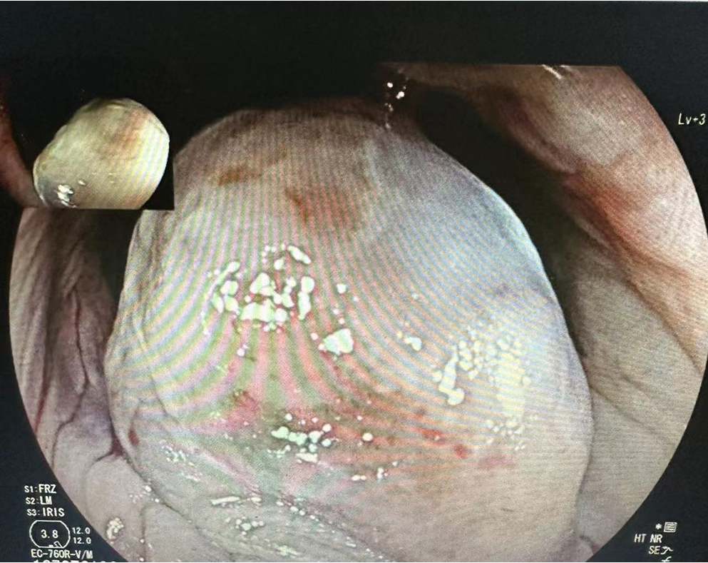 吴小材:一例被容易被漏诊的肛管恶性黑色素瘤