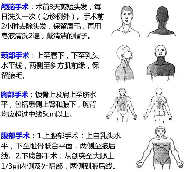 为什么要叫备皮刀“感术 ”行动 ｜｜ 院感说备皮刀不符合要求，备皮怎么办？常见备皮、消毒范围_https://www.jmylbn.com_新闻资讯_第3张
