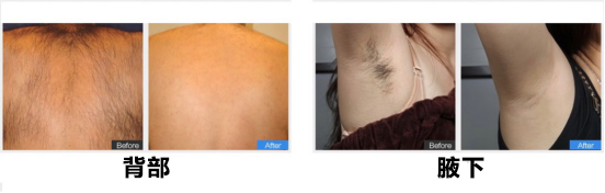 为什么要叫备皮刀“感术 ”行动 ｜｜ 院感说备皮刀不符合要求，备皮怎么办？常见备皮、消毒范围_https://www.jmylbn.com_新闻资讯_第19张