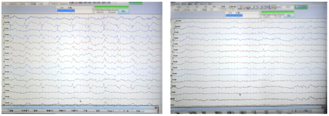 什么视频脑电图视频脑电监测是什么？哪些人需要做该检查？_https://www.jmylbn.com_新闻资讯_第3张