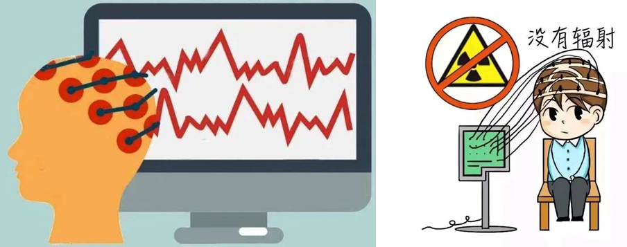 什么视频脑电图视频脑电监测是什么？哪些人需要做该检查？_https://www.jmylbn.com_新闻资讯_第6张