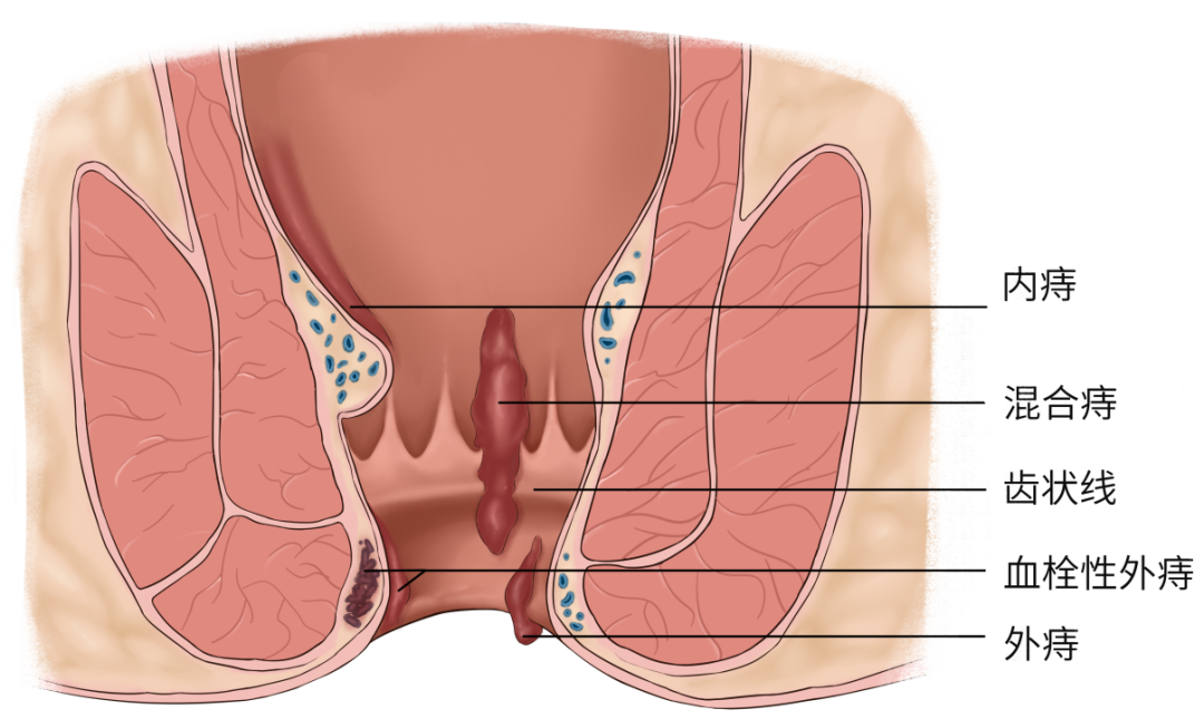 厂痔疮怎么处理肛门长了块“肉揪揪”怎么处理？以下这几种情况建议赶紧切除！_https://www.jmylbn.com_新闻资讯_第3张