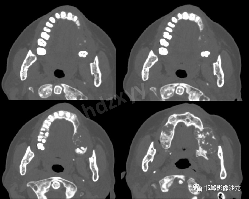 牙源性纤维瘤影像诊断与鉴别_医学界-助力医生临床决策和职业成长