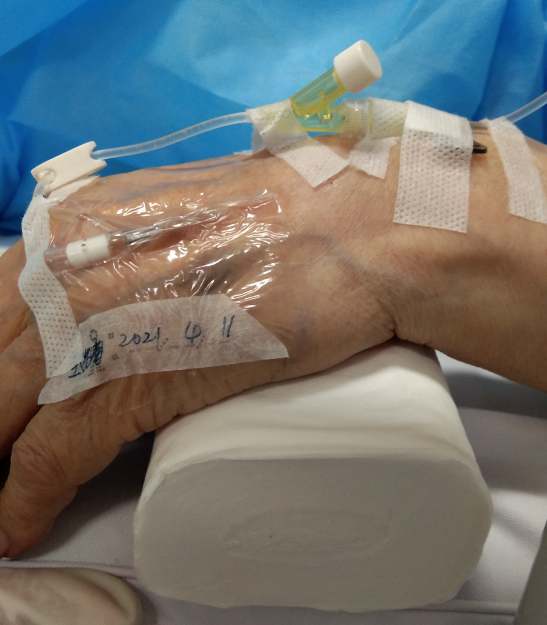 静脉留置针是干什么的留置针穿刺的最佳部位是哪里？别纠结，答案来了！_https://www.jmylbn.com_新闻资讯_第5张