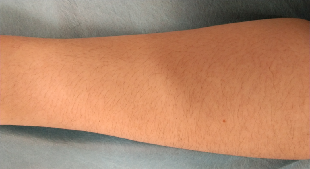 静脉留置针是干什么的留置针穿刺的最佳部位是哪里？别纠结，答案来了！_https://www.jmylbn.com_新闻资讯_第10张