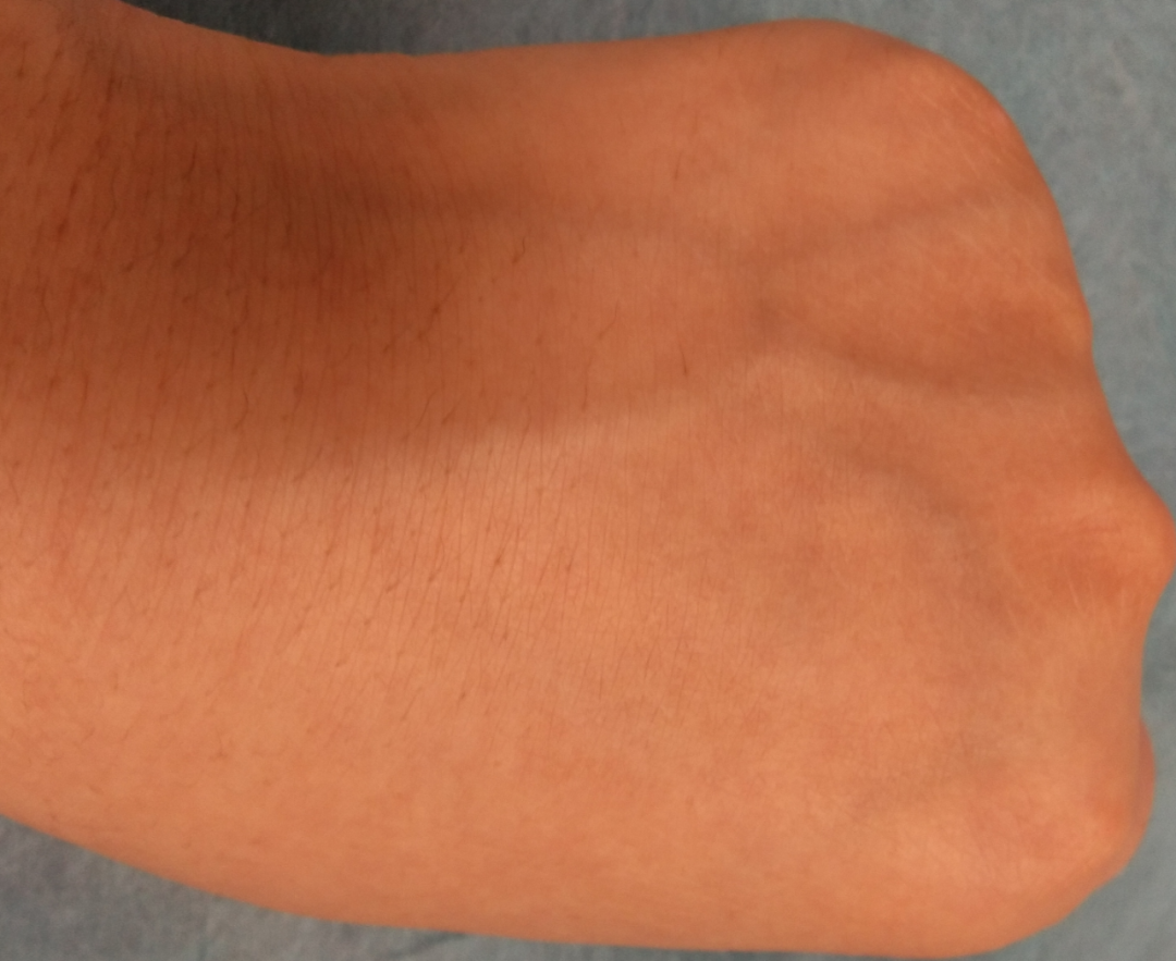 静脉留置针是干什么的留置针穿刺的最佳部位是哪里？别纠结，答案来了！_https://www.jmylbn.com_新闻资讯_第8张