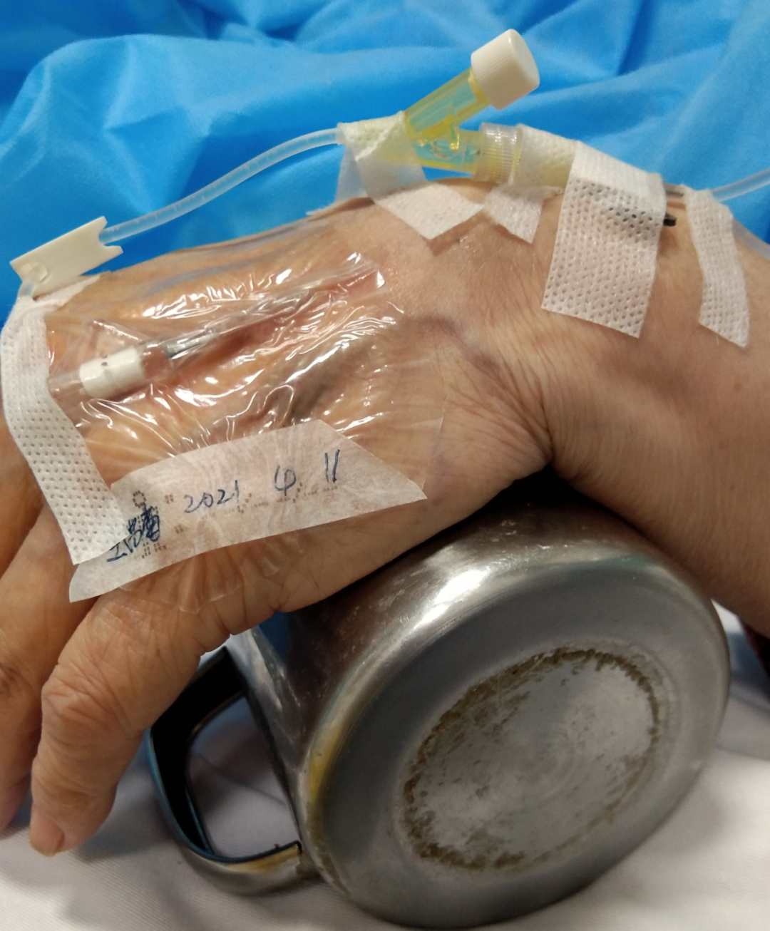 静脉留置针是干什么的留置针穿刺的最佳部位是哪里？别纠结，答案来了！_https://www.jmylbn.com_新闻资讯_第7张