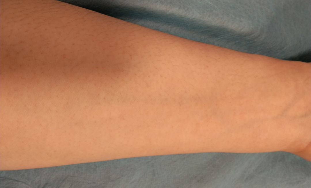 静脉留置针是干什么的留置针穿刺的最佳部位是哪里？别纠结，答案来了！_https://www.jmylbn.com_新闻资讯_第9张