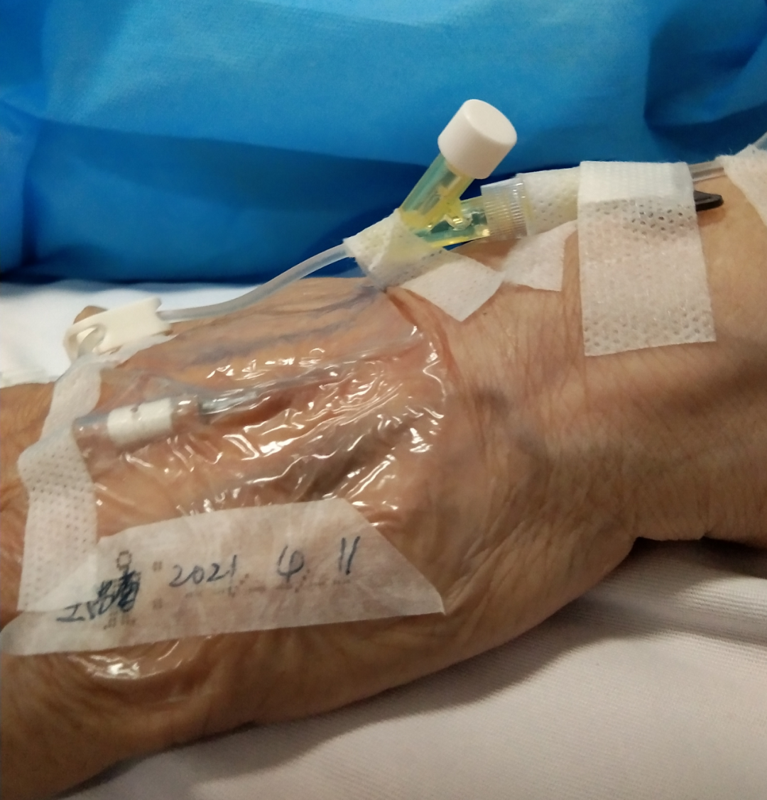 静脉留置针是干什么的留置针穿刺的最佳部位是哪里？别纠结，答案来了！_https://www.jmylbn.com_新闻资讯_第4张