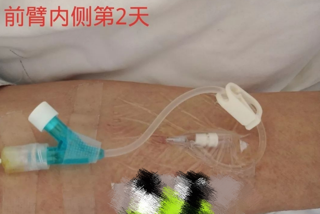 静脉留置针是干什么的留置针穿刺的最佳部位是哪里？别纠结，答案来了！_https://www.jmylbn.com_新闻资讯_第12张