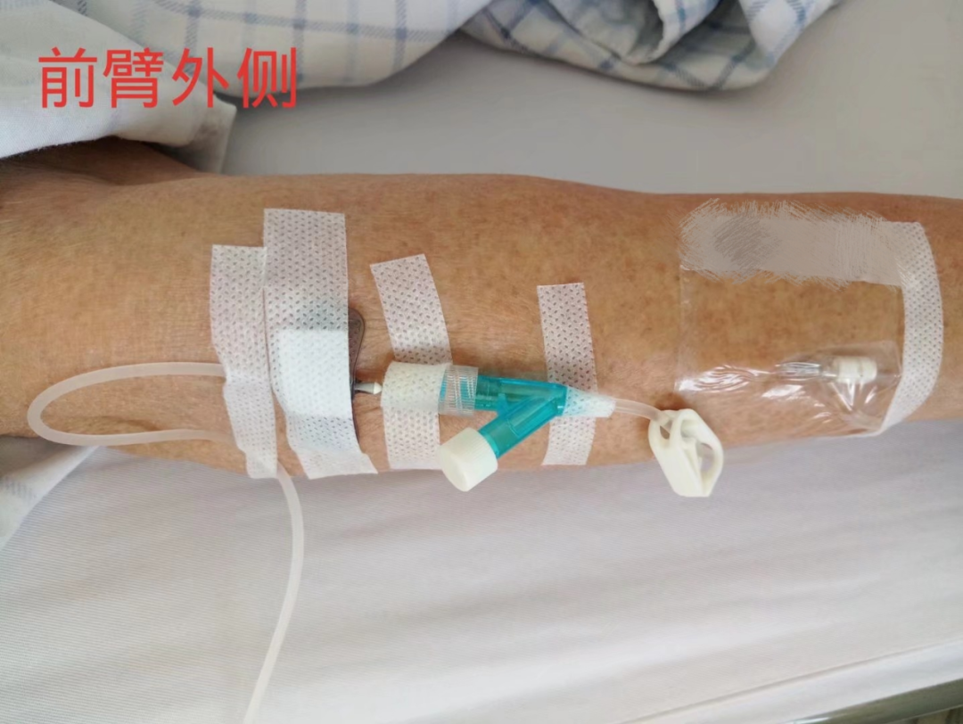 静脉留置针是干什么的留置针穿刺的最佳部位是哪里？别纠结，答案来了！_https://www.jmylbn.com_新闻资讯_第3张