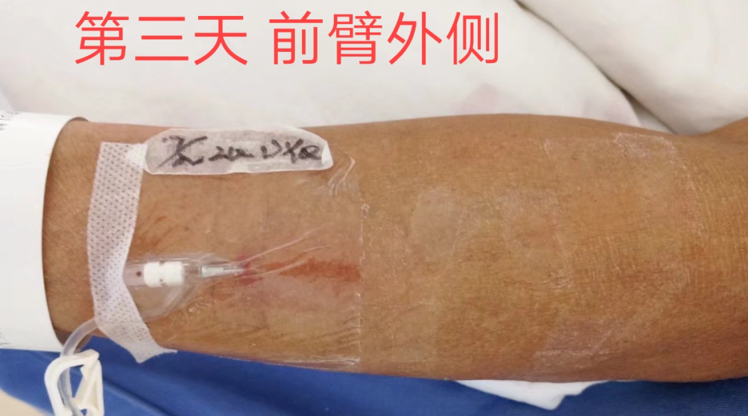 静脉留置针是干什么的留置针穿刺的最佳部位是哪里？别纠结，答案来了！_https://www.jmylbn.com_新闻资讯_第13张