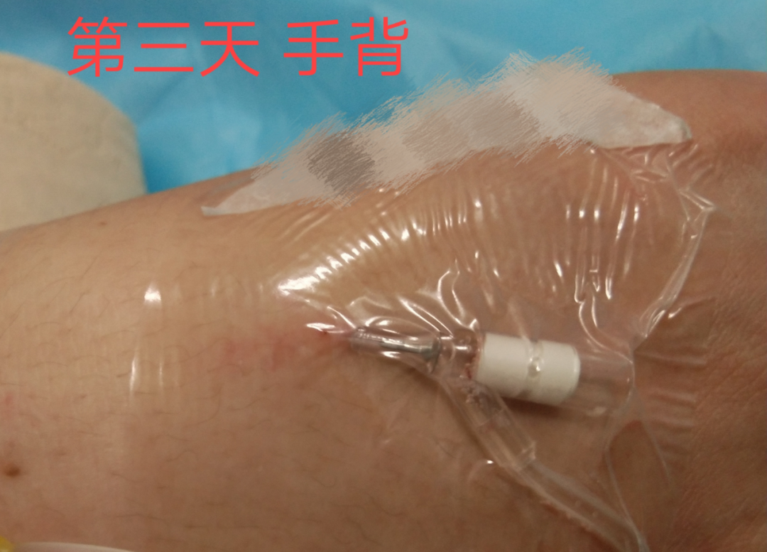 静脉留置针是干什么的留置针穿刺的最佳部位是哪里？别纠结，答案来了！_https://www.jmylbn.com_新闻资讯_第11张