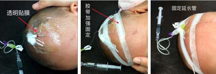 留置针绷带怎么缠小儿静脉留置针的7个固定小妙招，儿科护士都学起来！_https://www.jmylbn.com_新闻资讯_第6张