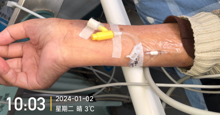 为什么国外不用y型留置针价格留置针一定要 U 型固定吗？这样做才是最合适的_https://www.jmylbn.com_新闻资讯_第8张