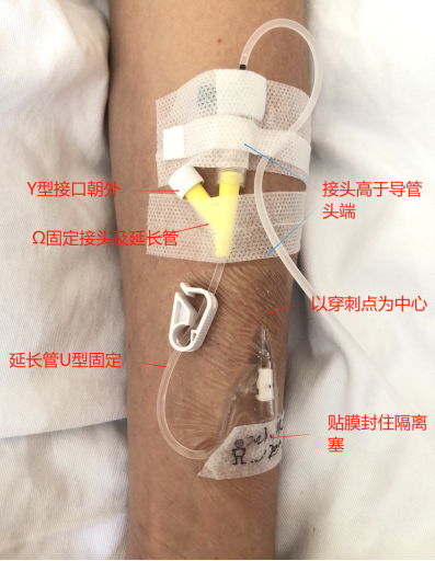 为什么国外不用y型留置针价格留置针一定要 U 型固定吗？这样做才是最合适的_https://www.jmylbn.com_新闻资讯_第3张