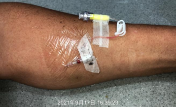 为什么国外不用y型留置针价格留置针一定要 U 型固定吗？这样做才是最合适的_https://www.jmylbn.com_新闻资讯_第7张