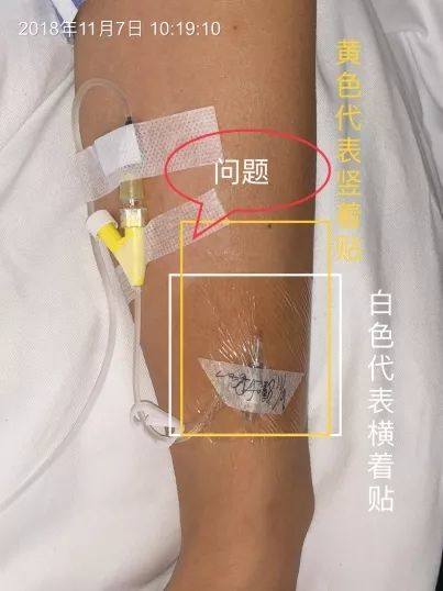 留置针怎么贴膜留置针贴膜到底怎么贴？90% 护士都错了！_https://www.jmylbn.com_新闻资讯_第4张