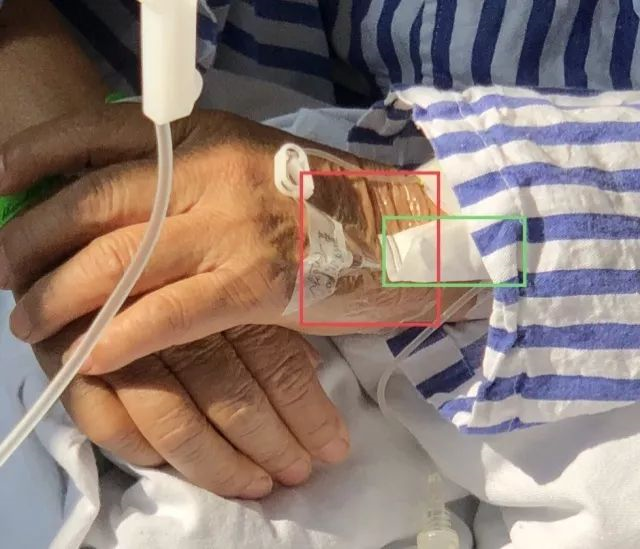 留置针怎么贴膜留置针贴膜到底怎么贴？90% 护士都错了！_https://www.jmylbn.com_新闻资讯_第5张