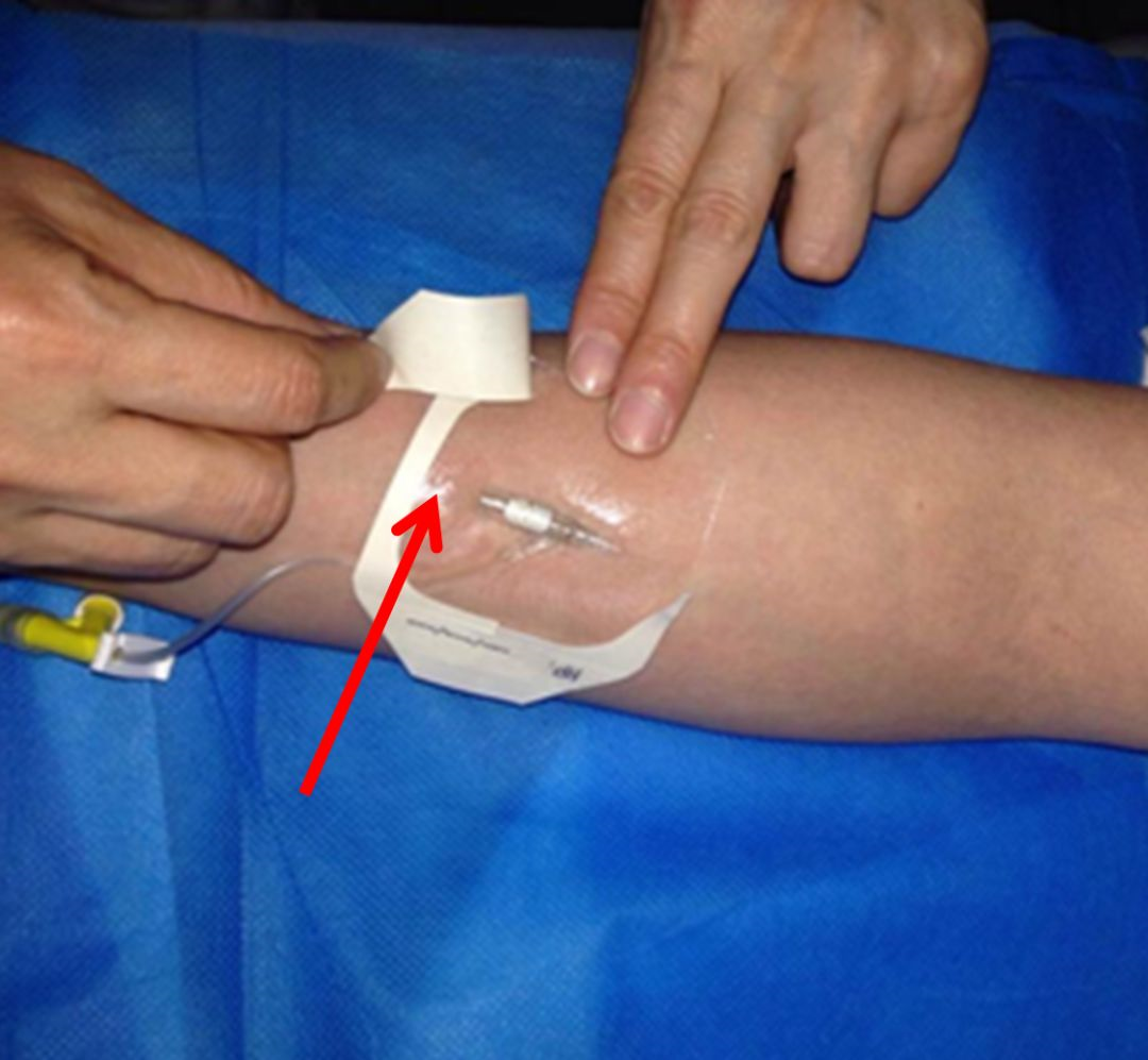 留置针怎么贴膜留置针贴膜到底怎么贴？90% 护士都错了！_https://www.jmylbn.com_新闻资讯_第6张