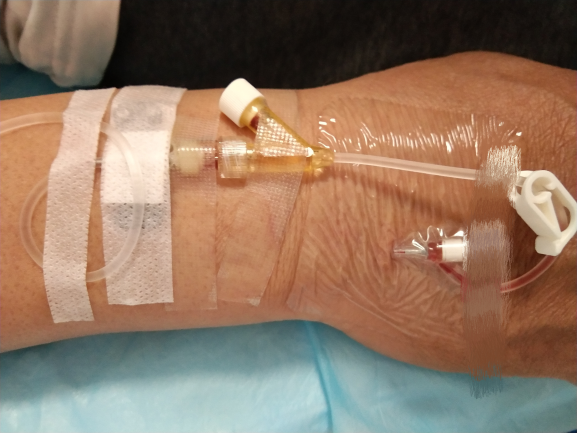 普通留置针怎么固定留置针一定要U型固定吗？这样做才是最合适的_https://www.jmylbn.com_新闻资讯_第8张