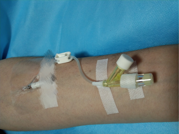 普通留置针怎么固定留置针一定要U型固定吗？这样做才是最合适的_https://www.jmylbn.com_新闻资讯_第4张