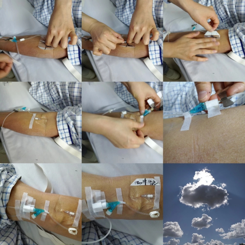 普通留置针怎么固定留置针一定要U型固定吗？这样做才是最合适的_https://www.jmylbn.com_新闻资讯_第10张