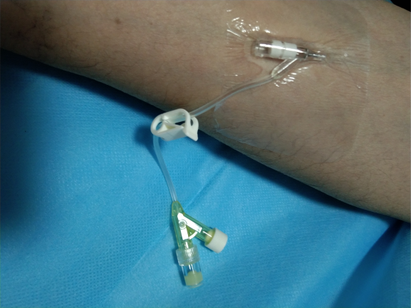 普通留置针怎么固定留置针一定要U型固定吗？这样做才是最合适的_https://www.jmylbn.com_新闻资讯_第7张