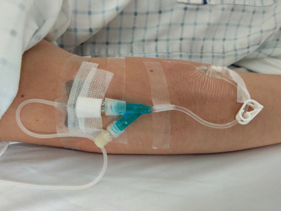 普通留置针怎么固定留置针一定要U型固定吗？这样做才是最合适的_https://www.jmylbn.com_新闻资讯_第5张