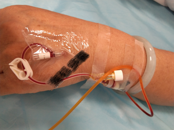 普通留置针怎么固定留置针一定要U型固定吗？这样做才是最合适的_https://www.jmylbn.com_新闻资讯_第6张