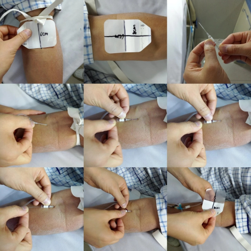 普通留置针怎么固定留置针一定要U型固定吗？这样做才是最合适的_https://www.jmylbn.com_新闻资讯_第9张