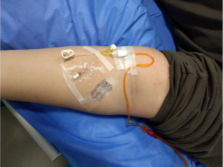 普通留置针怎么固定留置针一定要U型固定吗？这样做才是最合适的_https://www.jmylbn.com_新闻资讯_第3张