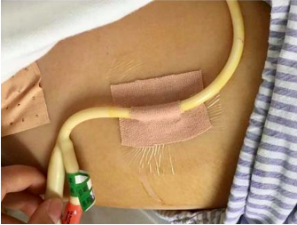 尿管怎么固定导尿管为什么要二次固定？看完视频我终于明白了_https://www.jmylbn.com_新闻资讯_第3张