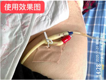 尿管怎么固定导尿管为什么要二次固定？看完视频我终于明白了_https://www.jmylbn.com_新闻资讯_第4张