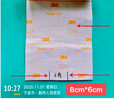 尿管怎么固定导尿管为什么要二次固定？看完视频我终于明白了_https://www.jmylbn.com_新闻资讯_第5张
