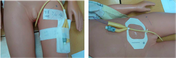 尿管怎么固定导尿管为什么要二次固定？看完视频我终于明白了_https://www.jmylbn.com_新闻资讯_第2张