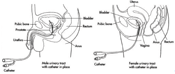 尿管怎么固定导尿管为什么要二次固定？看完视频我终于明白了_https://www.jmylbn.com_新闻资讯_第1张