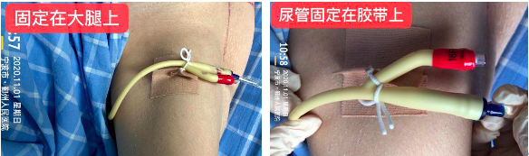 尿管怎么固定导尿管为什么要二次固定？看完视频我终于明白了_https://www.jmylbn.com_新闻资讯_第8张