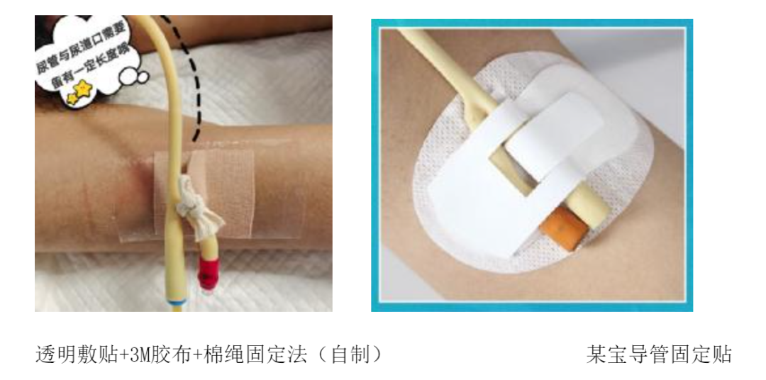 怎么固定导尿管导尿管堵塞怎么办？6 招教你解决导尿管常见问题_https://www.jmylbn.com_新闻资讯_第2张