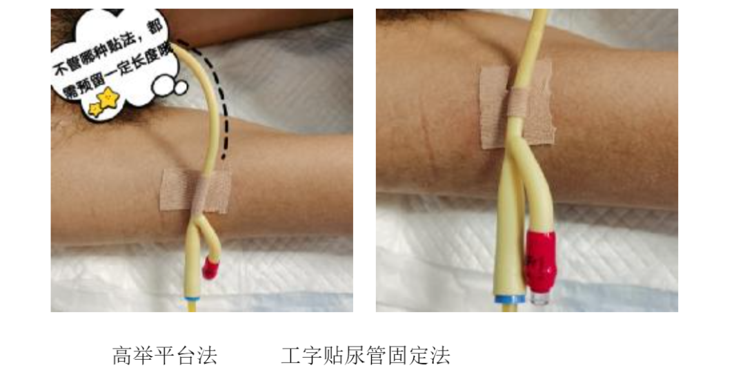 怎么固定导尿管导尿管堵塞怎么办？6 招教你解决导尿管常见问题_https://www.jmylbn.com_新闻资讯_第3张