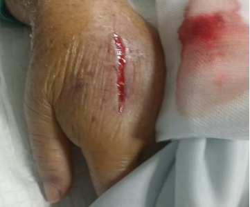 为什么输液管要粘上面近 7 cm 裂口不缝合！护士用 4 张输液贴就“粘”好了_https://www.jmylbn.com_新闻资讯_第2张