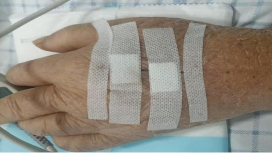 为什么输液管要粘上面近 7 cm 裂口不缝合！护士用 4 张输液贴就“粘”好了_https://www.jmylbn.com_新闻资讯_第3张
